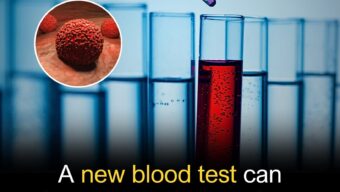 Researchers found that cancer-related genetic mutations could be detected as early as 3.1 to 3.5 years before diagnosis