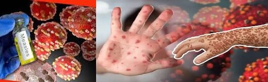হাম ও হামের উপসর্গে প্রাণহানি ১১০০ ছাড়ালো